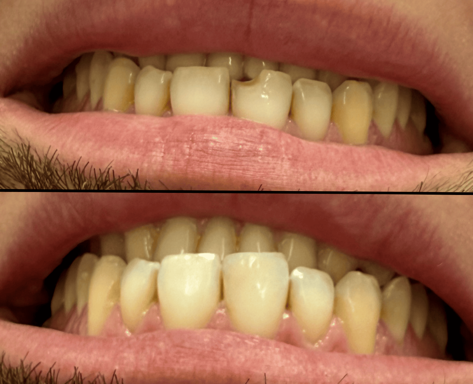 Restauração estética em resina com resultado natural