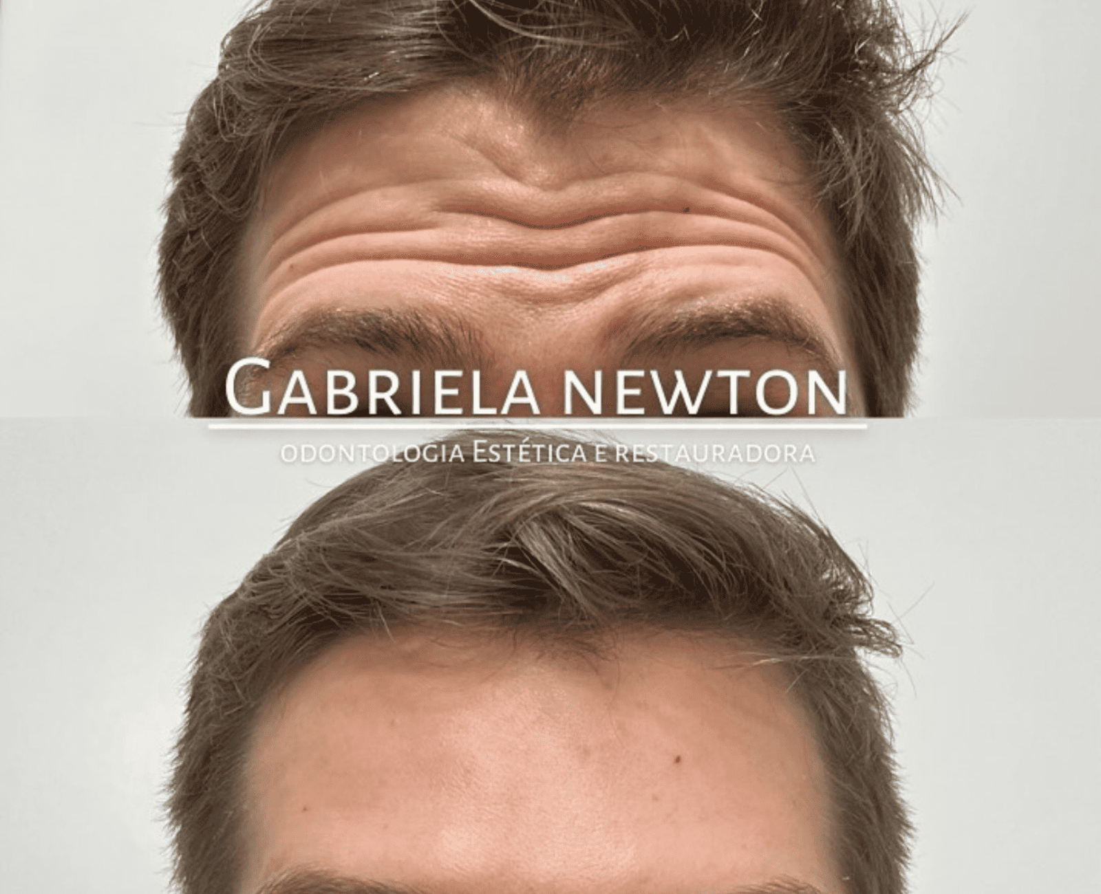 Aplicação de Botox facial com naturalidade e segurança